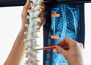 Nova cirurgia para correção de escoliose chega ao Brasil