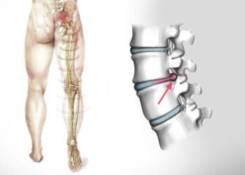 Nervo ciático e hérnia de disco: 06 informações que você precisa saber