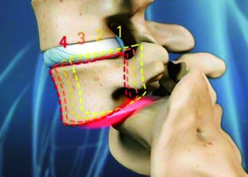 Já ouviu falar da dor sacro ilíaca, também conhecida como a “dor esquecida”?
