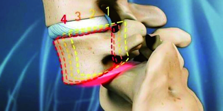 Já ouviu falar da dor sacro ilíaca, também conhecida como a “dor esquecida”?