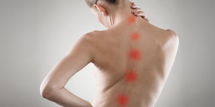 Cinco informações que você precisa saber sobre a escoliose - Dr. Alexandre Elias