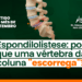 Espondilolistese: por que uma vértebra da coluna “escorrega”?